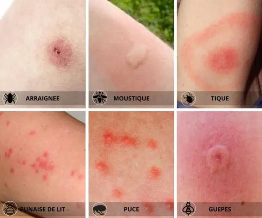 Piqure de punaise de lit 🐜 comment la reconnaître et agir